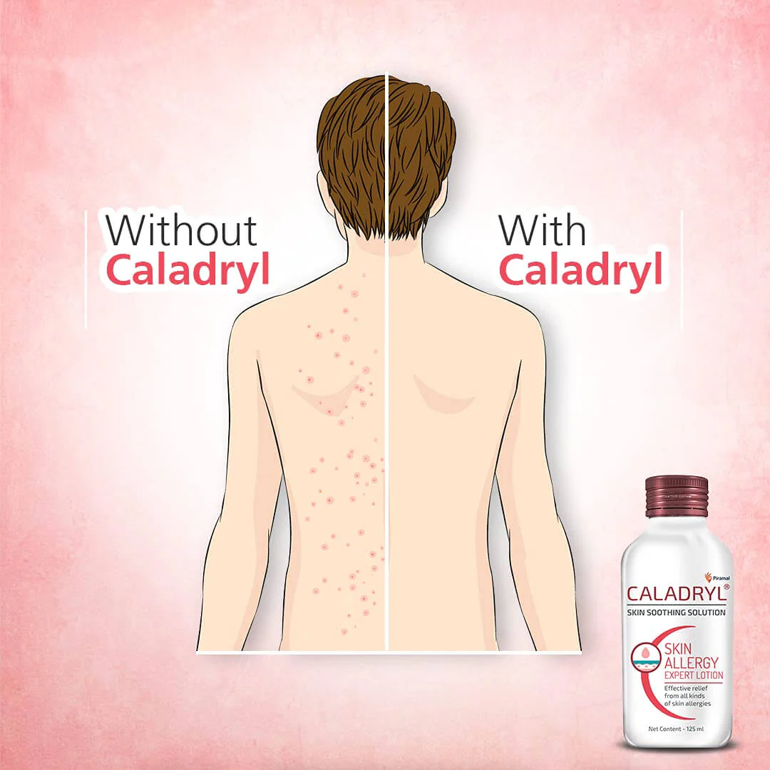 Caladryl Skin Allergy Expert Lotion (65ml/125ml) - Image 5